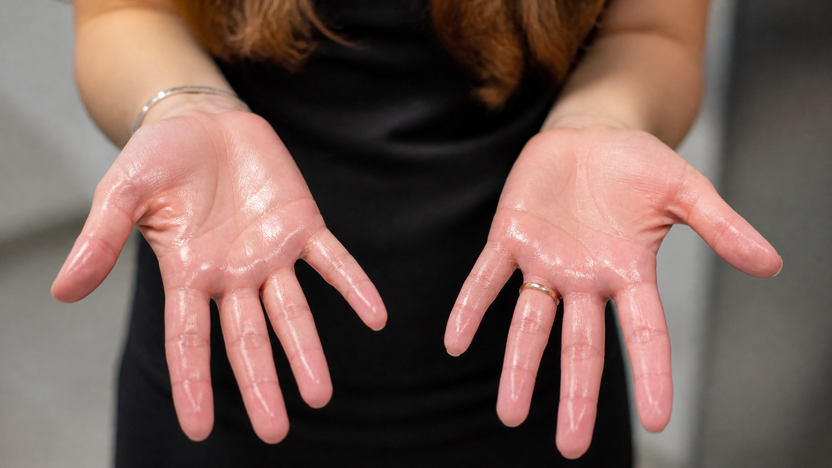 Understanding Hyperhidrosis: When Sweating Becomes More Than Just Cooling Down