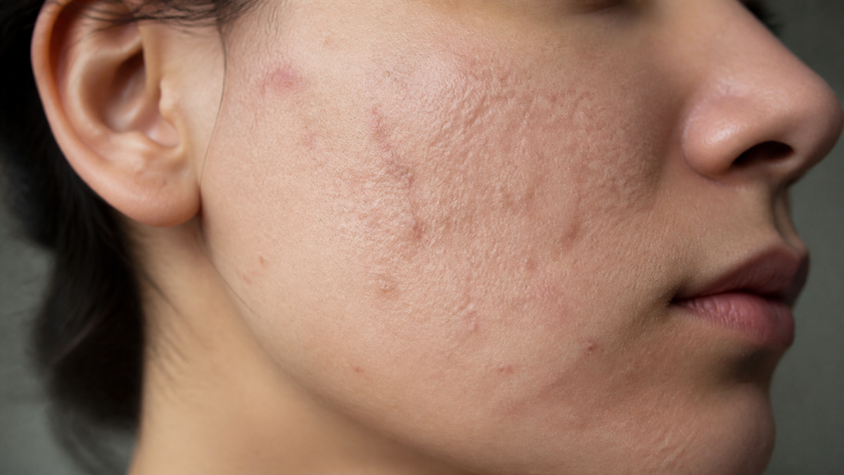 The Hidden Cost of Untreated Acne: Scarring, Hyperpigmentation, and Lasting Skin Damage
