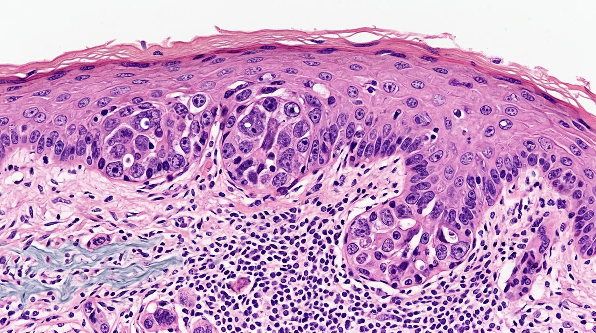 Spotting the Signs: What Is Lentigo Maligna and How Is It Treated?