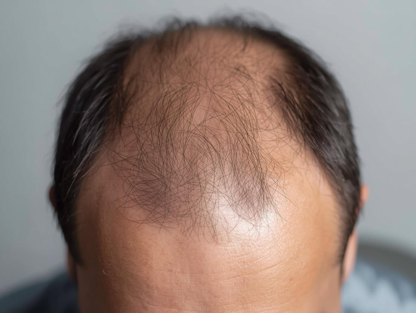 Hair loss consultations and treatments at Adare Dermatology