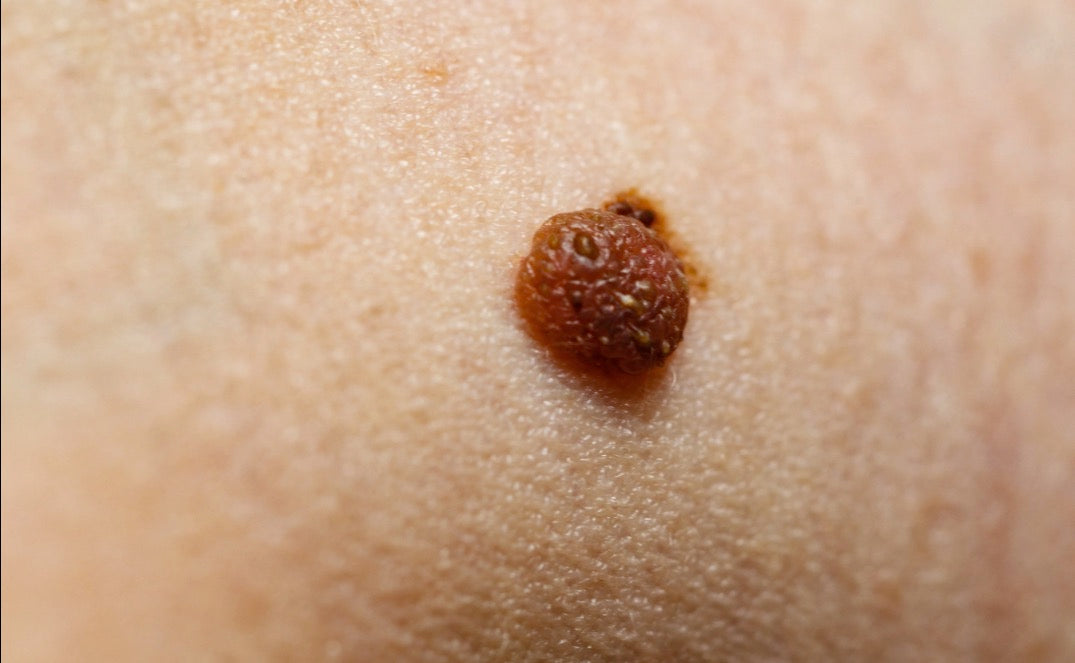 When something doesn't look right: Your guide to identifying suspicions moles and lesions.