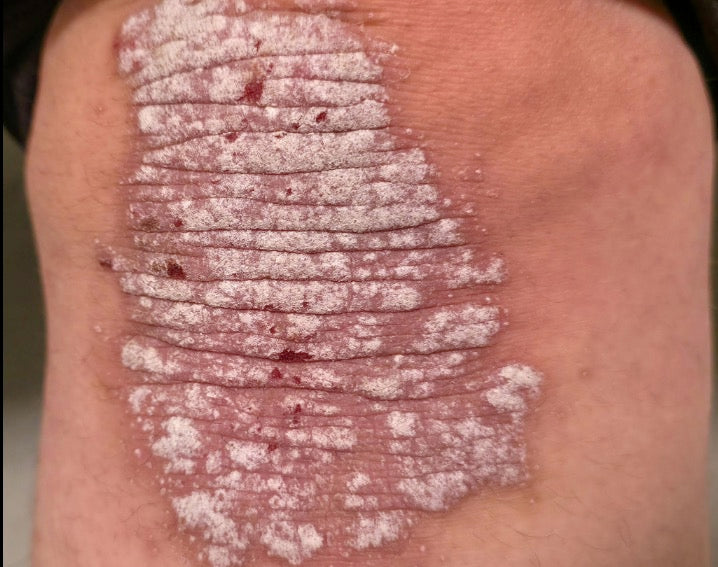 Chronic Inflammatory Skin Conditions: Why Expert Care Matters