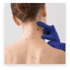 Mole Removal