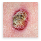Skin Cancer