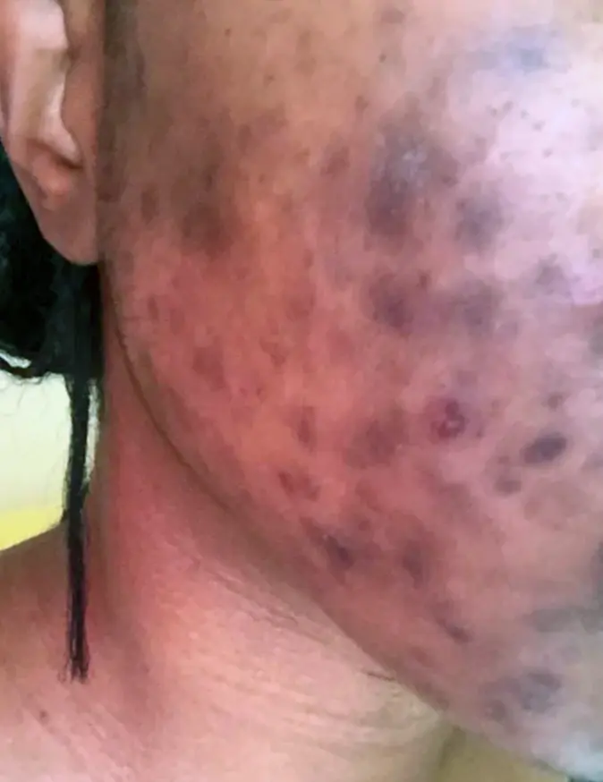 Hyperpigmentation