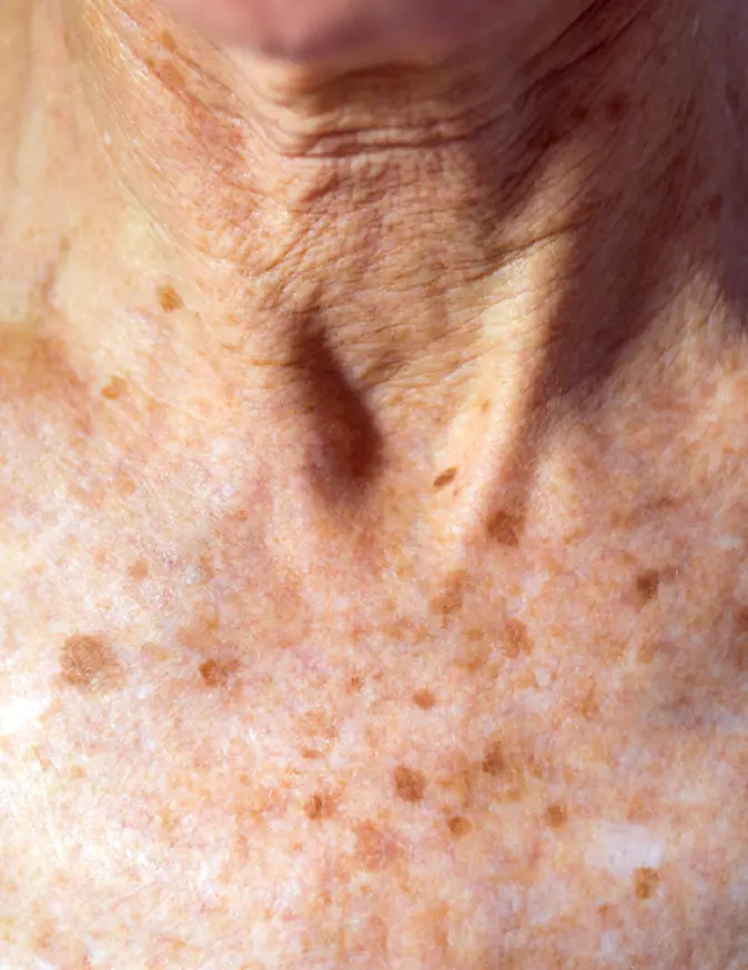 Age Spots