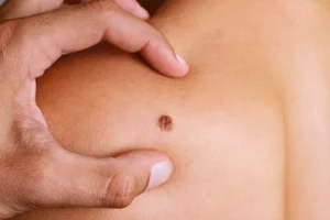 mole-removal
